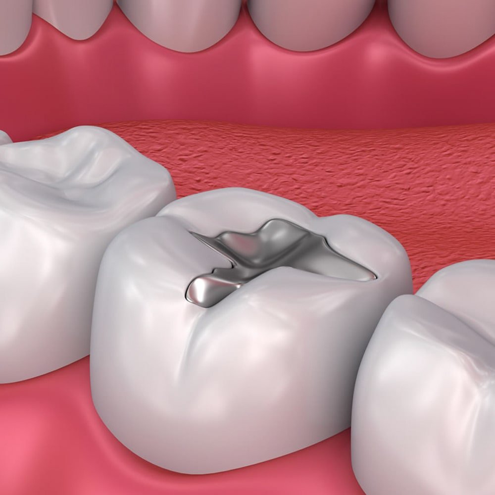Fillings-min