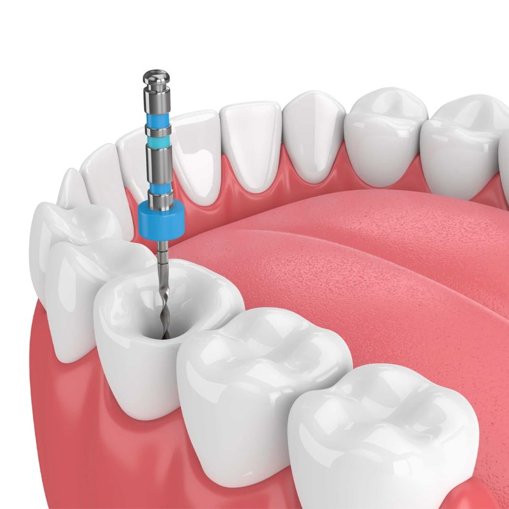 Root Canal-min