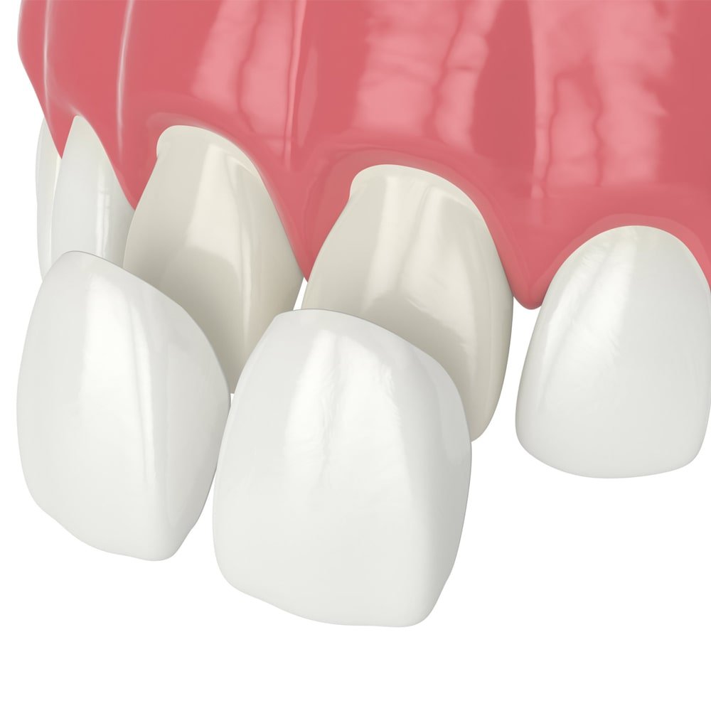 Veneers-min