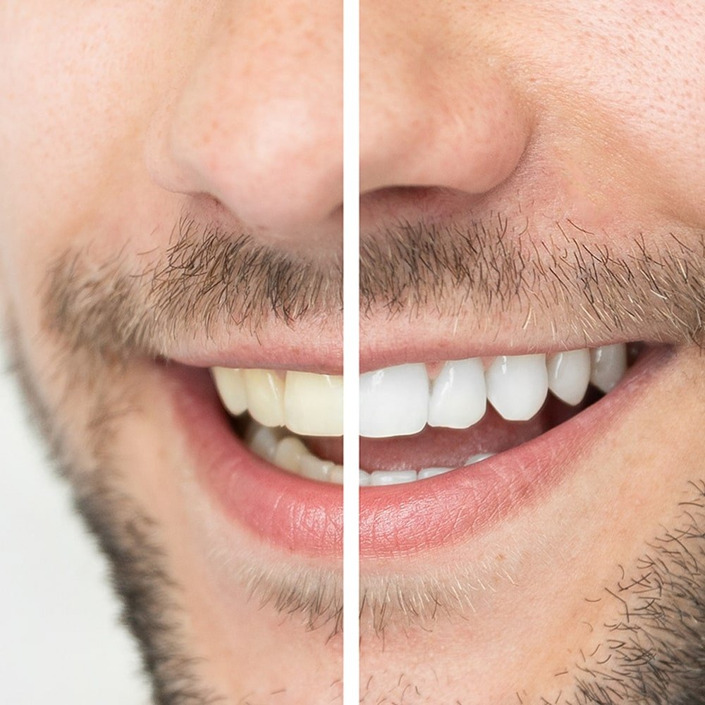Whitening-min