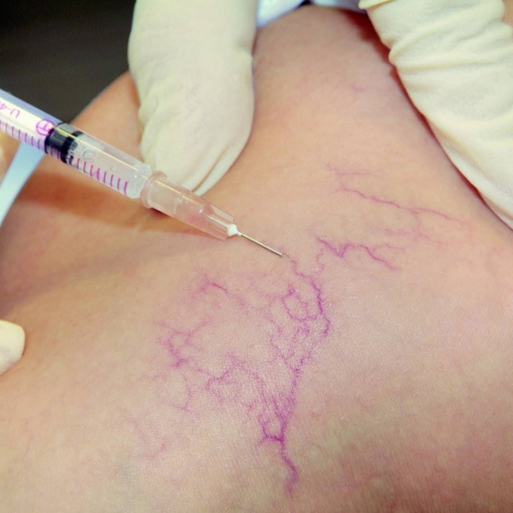 Sclerotherapy